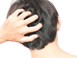 Ủ chấy bằng giấm – cách diệt chấy, an toàn hiệu quả Ủ chấy bằng giấm – cách diệt chấy, an toàn hiệu quả